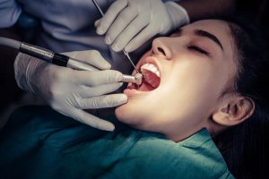 How Long Do Root Canals Last?