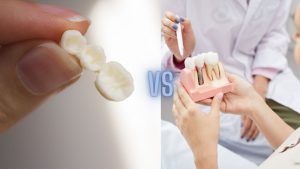 Dental Bridge Vs. Implant