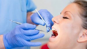 How Long are Dental Fillings Supposed to Last?