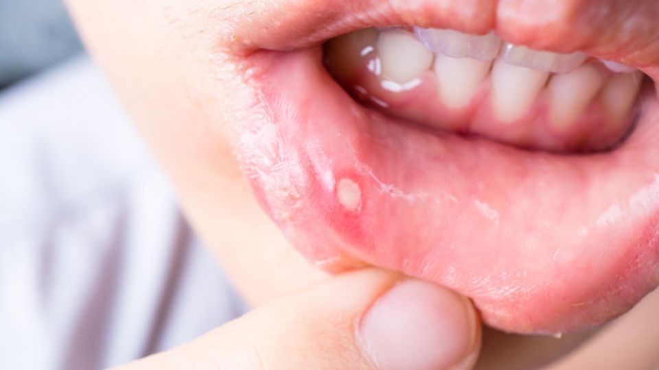 How to Heal a Mouth Sore