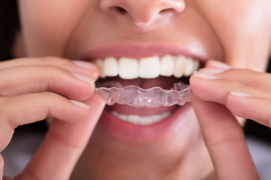 Patient Putting On An Invisalign