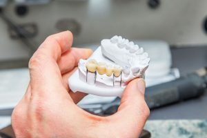 Decoding Dental Bridges: Restoring Your Smile