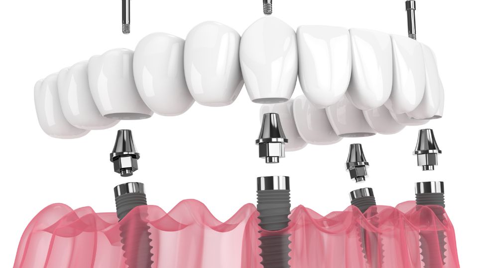 Dental Implant Materials What Are Implants Made Of?
